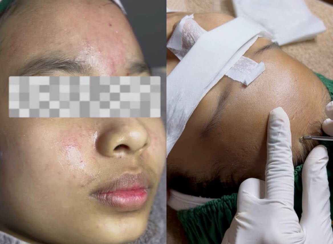 Apa Itu Komedo Tertutup, dan Bedanya dengan Bruntusan?