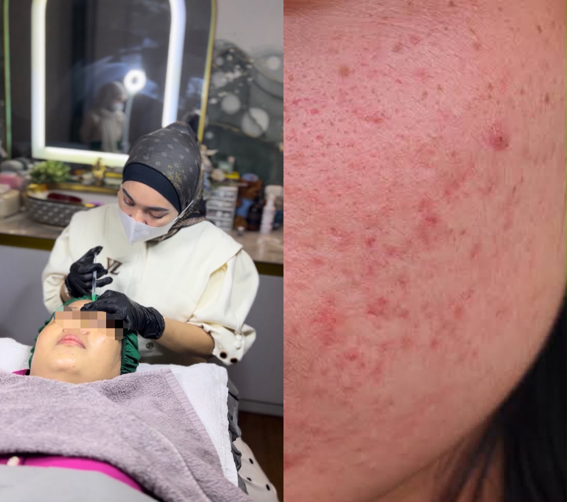 Apakah skinbooster aman untuk kulit sensitif?