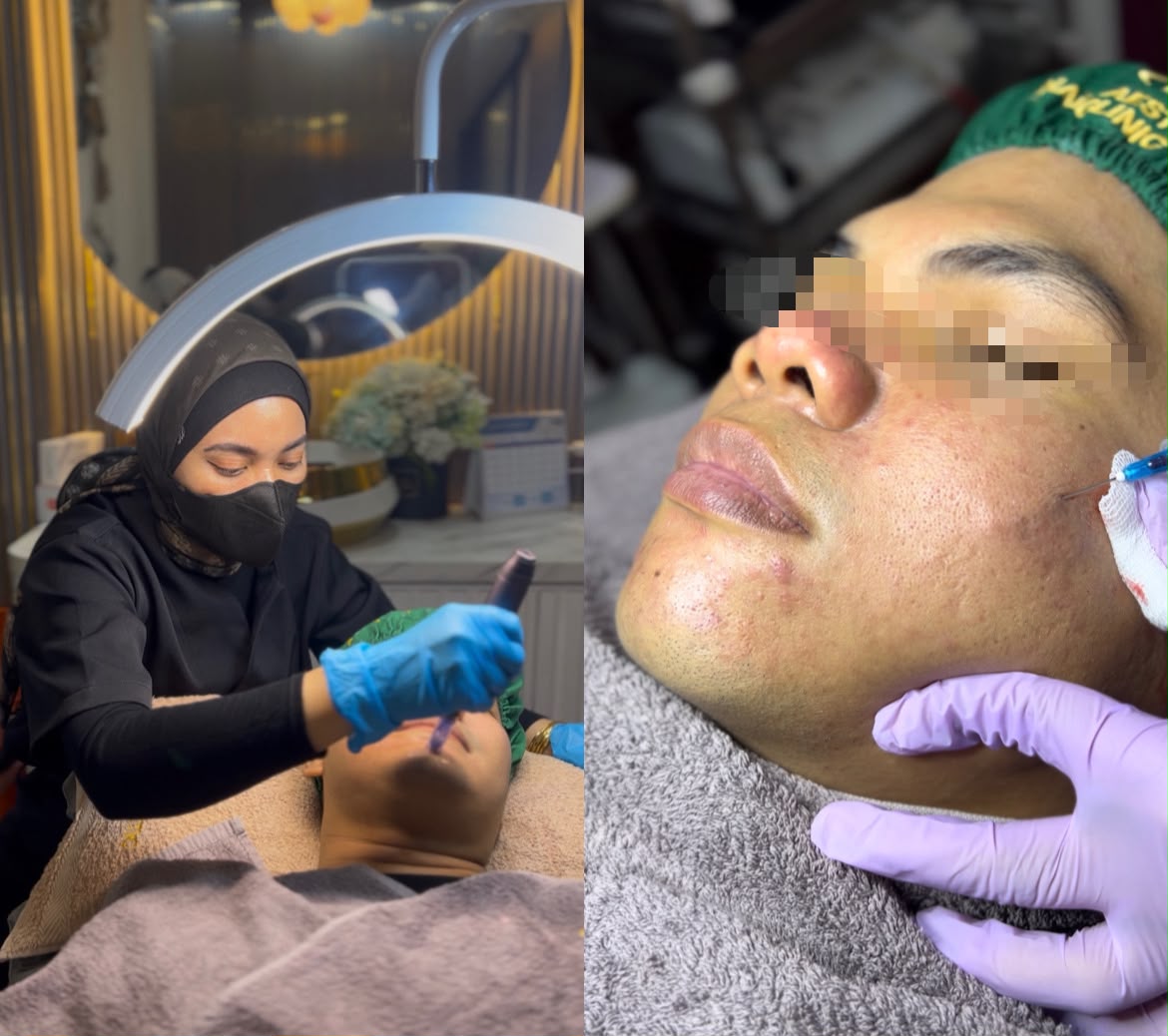 Tindakan treatment bekas jerawat bopeng oleh tenaga medis di Naba Aesthetic Clinic Citra Raya