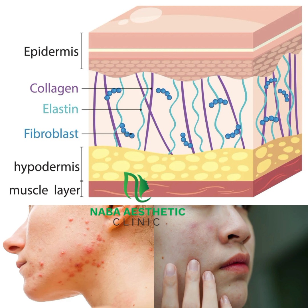 Ilustrasi istilah skincare: lapisan kulit epidermis, dermis dengan kolagen dan elastin, hipodermis, serta contoh kulit berjerawat