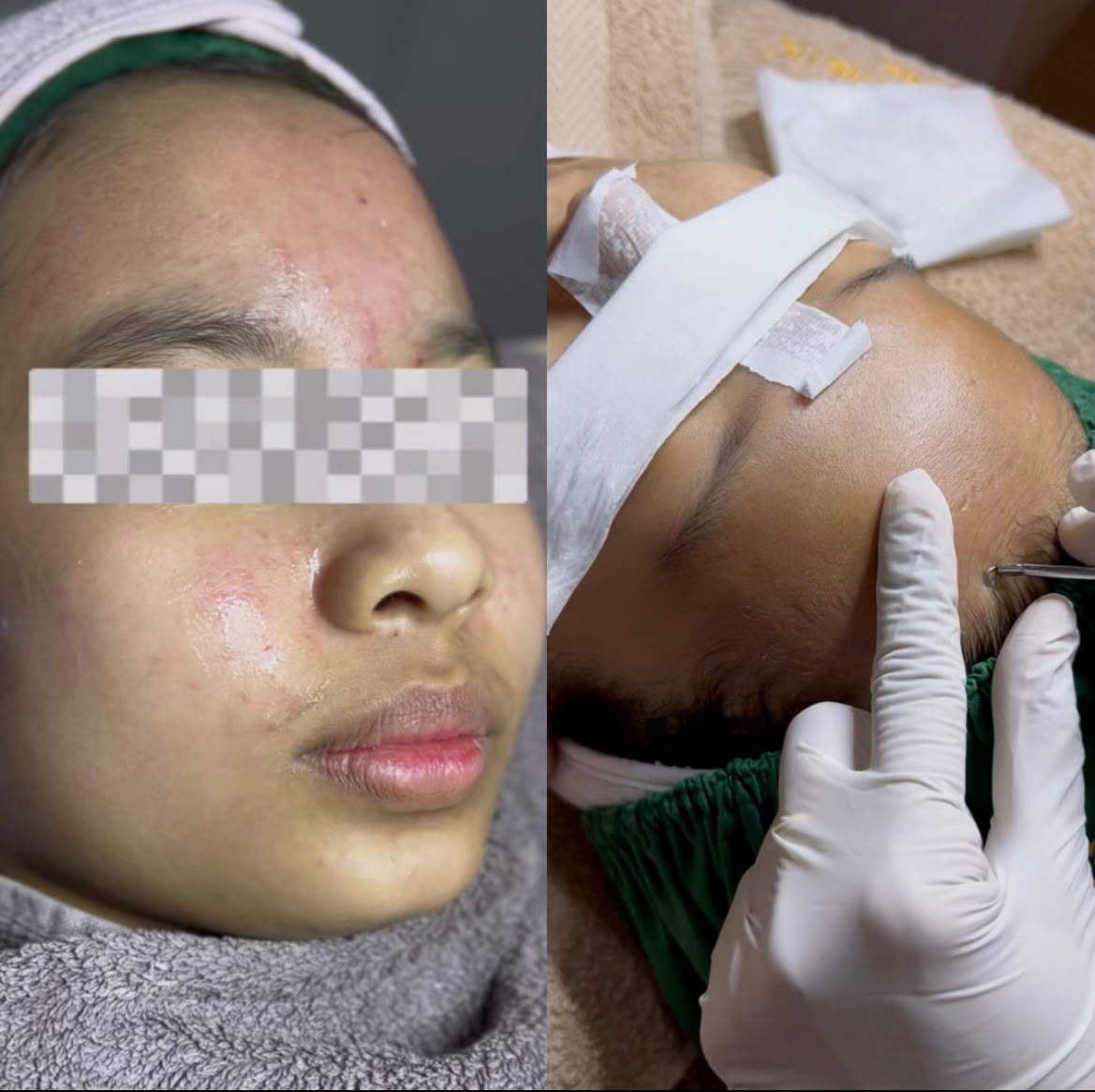 Kulit wajah dengan komedo tertutup dan bruntusan, serta proses pembersihan komedo saat facial