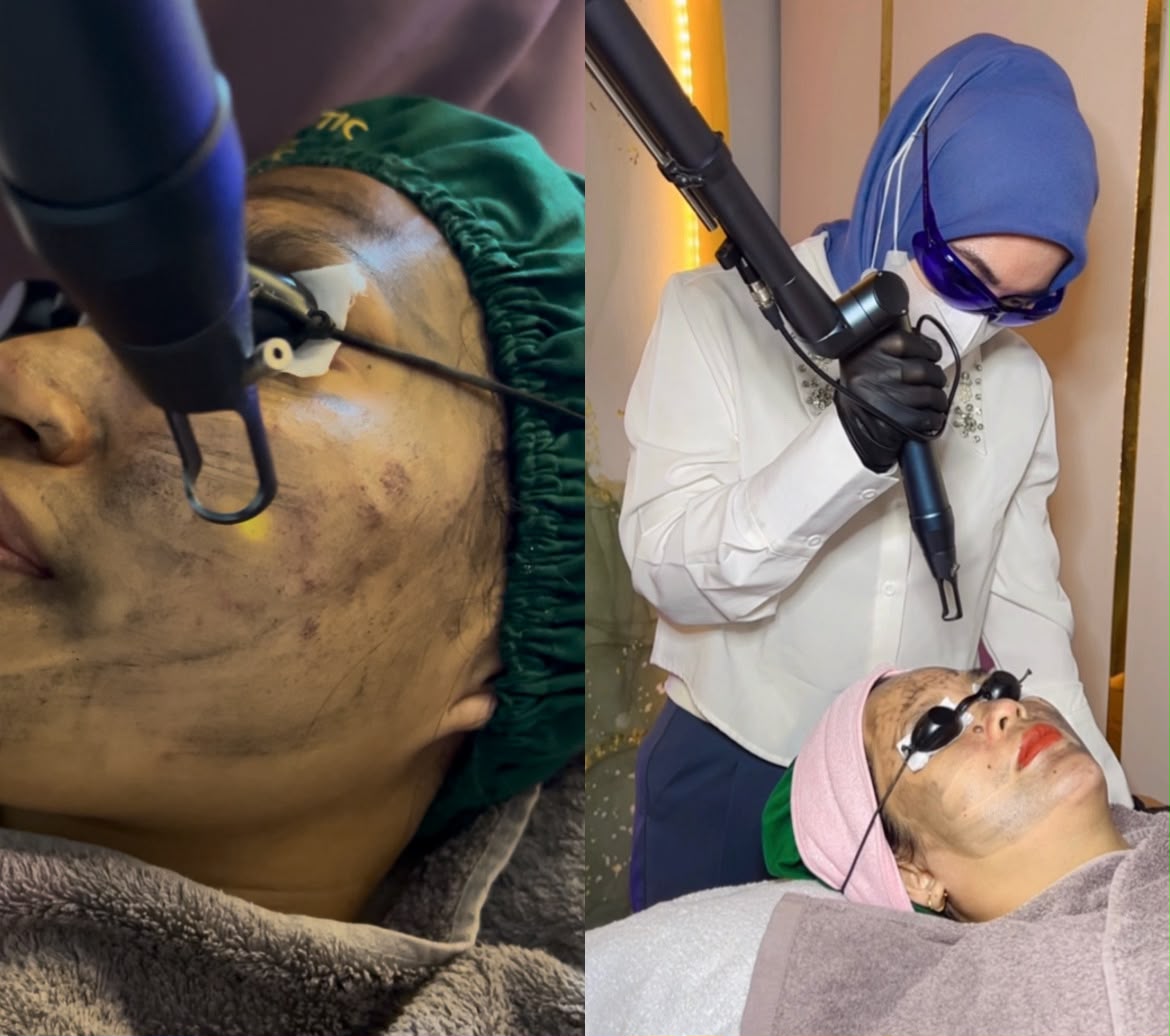 Dokter melakukan tindakan pico laser pada wajah pasien berkacamata pelindung di Naba Aesthetic Clinic Citra Raya
