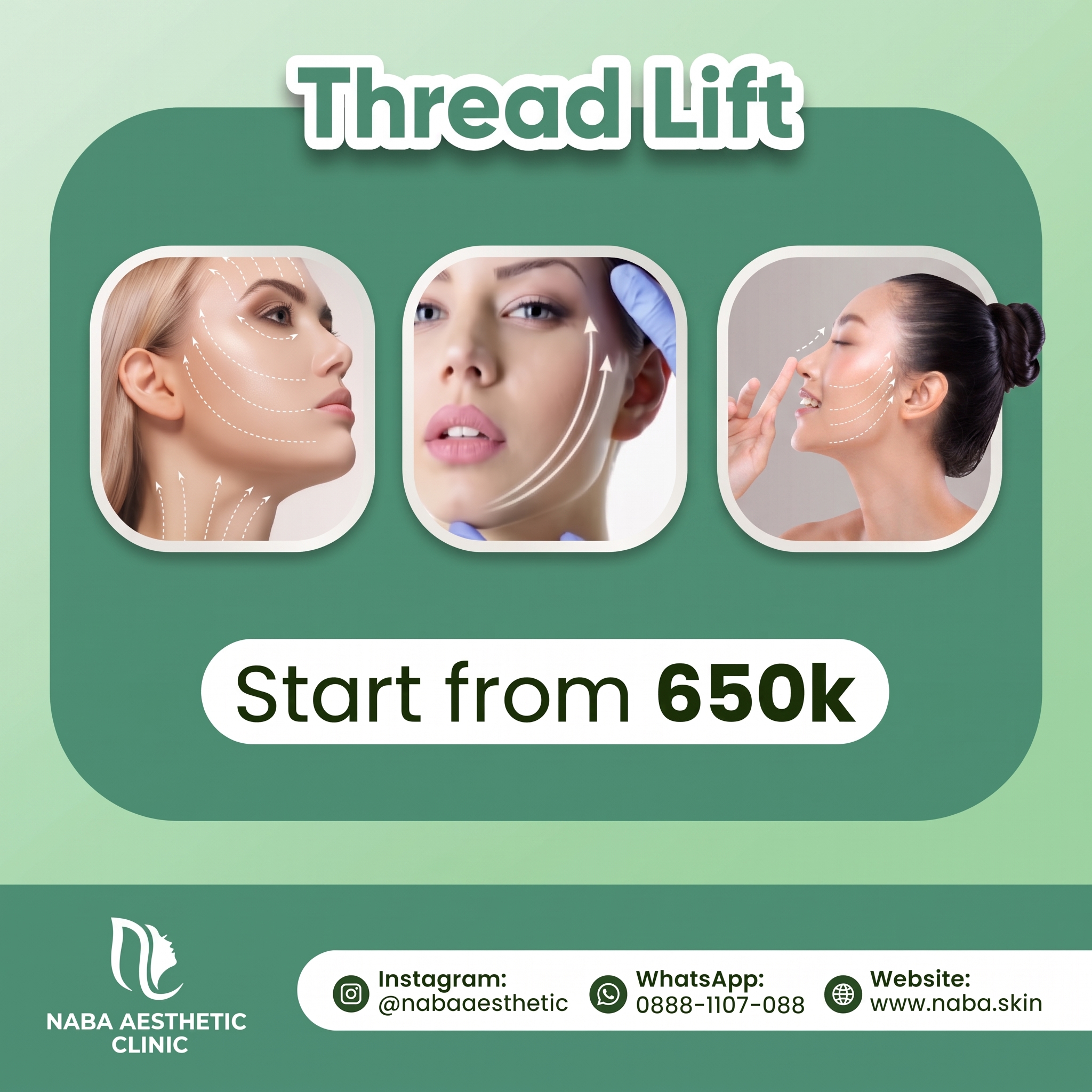 Thread Lift di Naba Aesthetic Clinic Citra Raya Tangerang