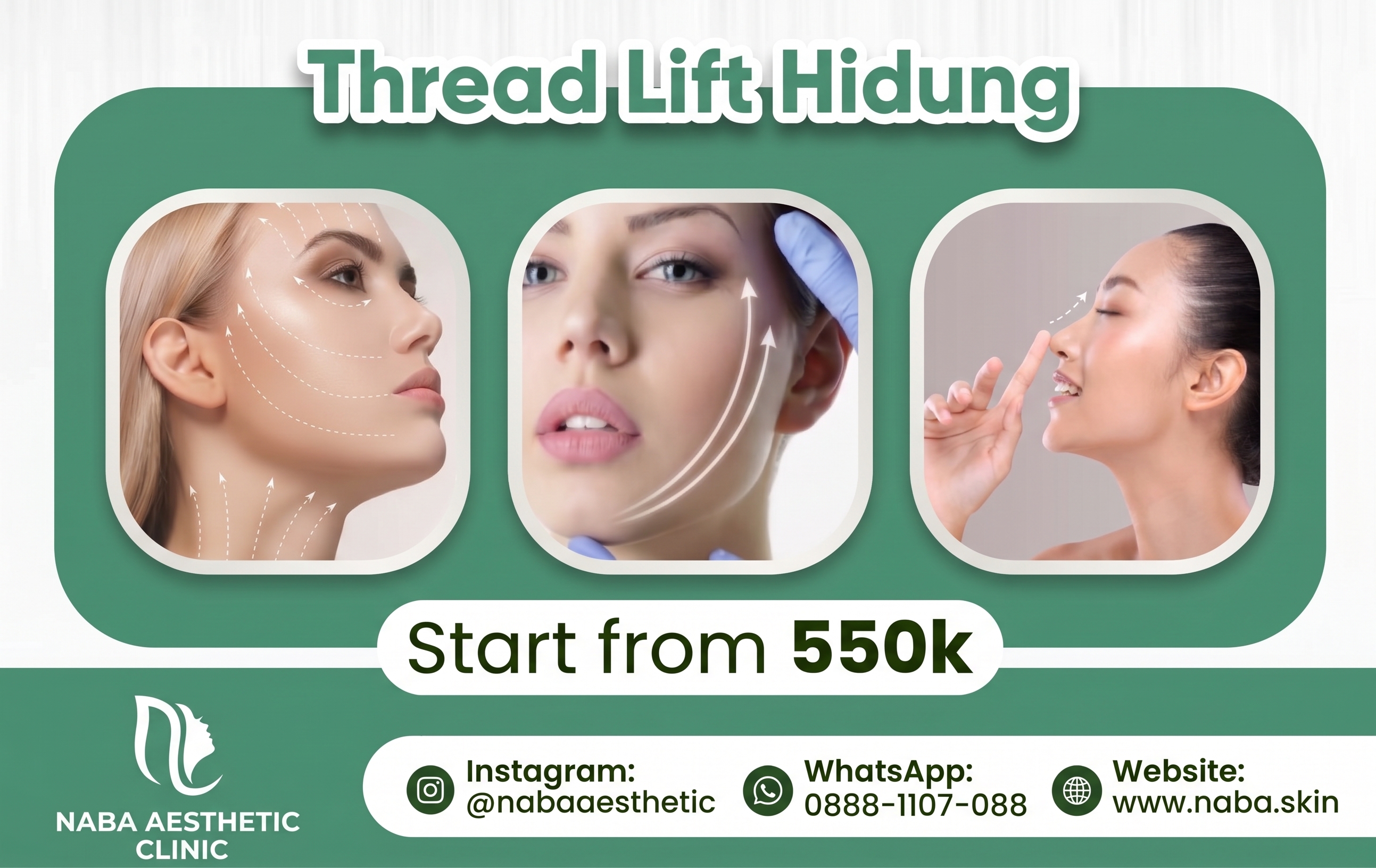 Thread Lift Hidung di Naba Aesthetic Clinic