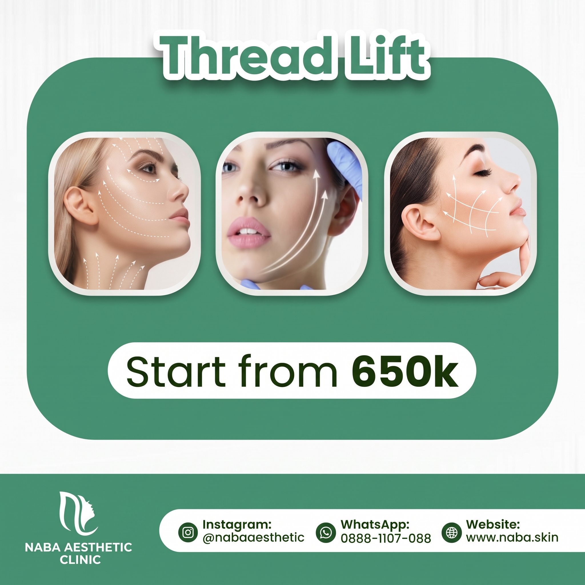 Thread Lift Pipi di Naba Aesthetic Clinic