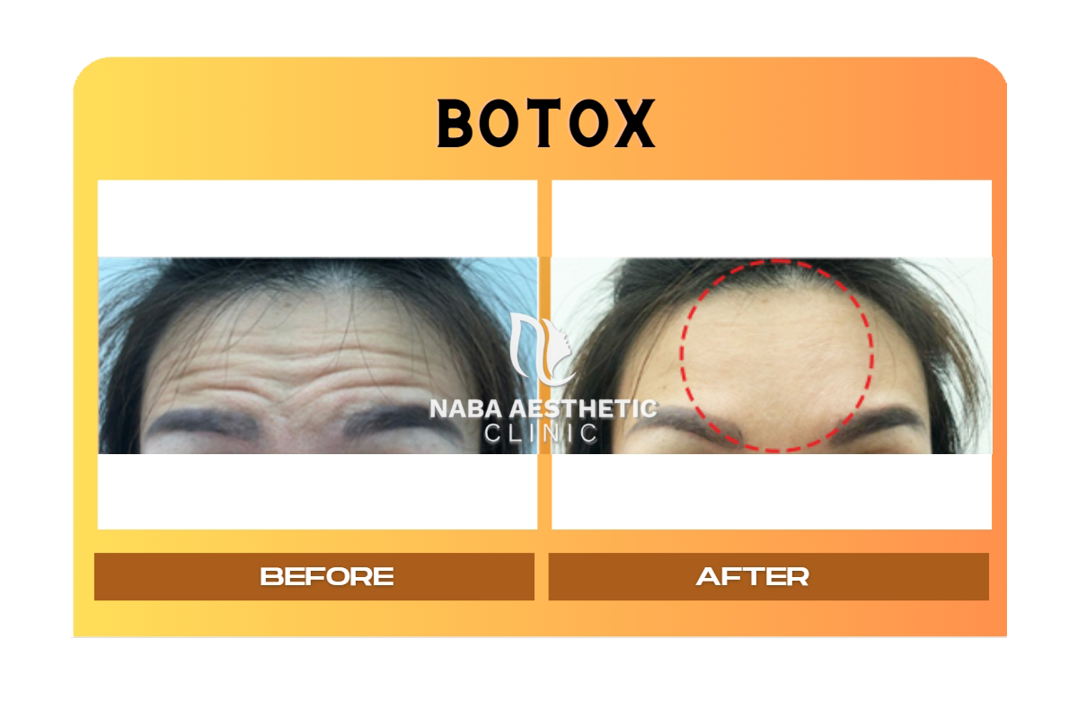 Treatment Botox Naba Aesthetic Clinic Citra Raya Cikupa Tangerang