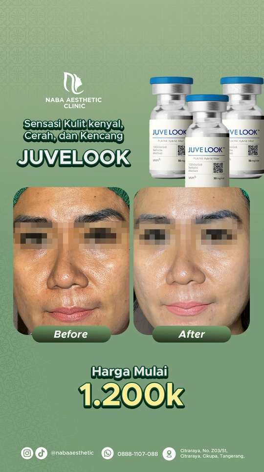 Treatment Juvelook di Naba Aesthetic Clinic Tangerang untuk kulit kenyal, cerah, dan kencang dengan hasil before after dan harga mulai 1.200k.