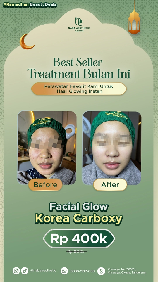 Promo Ramadhan Naba Aesthetic Clinic best seller Facial Glow Korea Carboxy dengan hasil glowing instan, before after treatment di Tangerang.