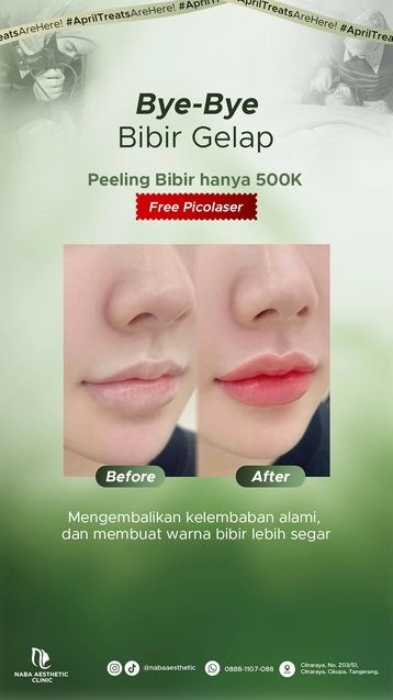 Hasil before after perawatan Peeling Bibir di Naba Aesthetic Clinic untuk mencerahkan bibir gelap, mengembalikan kelembapan alami, dan membuat warna bibir lebih segar.