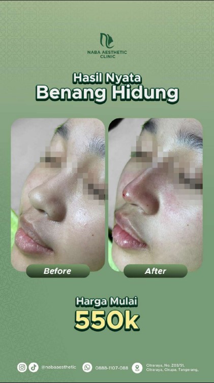 Foto Before After hasil perawatan kontur wajah tanam benang hidung di Klinik Kecantikan Citraraya - Tangerang Naba Aesthetic Clinic, menampilkan perubahan bentuk hidung yang lebih proporsional, tegas, dan mancung alami dengan harga promo mulai dari 550rb.