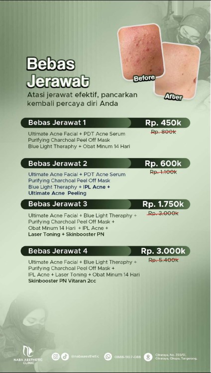 Foto Before After hasil perawatan jerawat di Klinik Kecantikan Citraraya - Tangerang Naba Aesthetic Clinic, menampilkan brosur daftar harga paket Bebas Jerawat 1 hingga Bebas Jerawat 4 dengan terapi Ultimate Acne Facial, Blue Light Therapy, IPL Acne, dan Skinbooster PN Vitaran